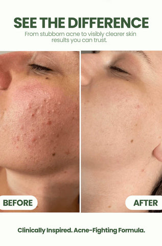 Anti Acne Serum
